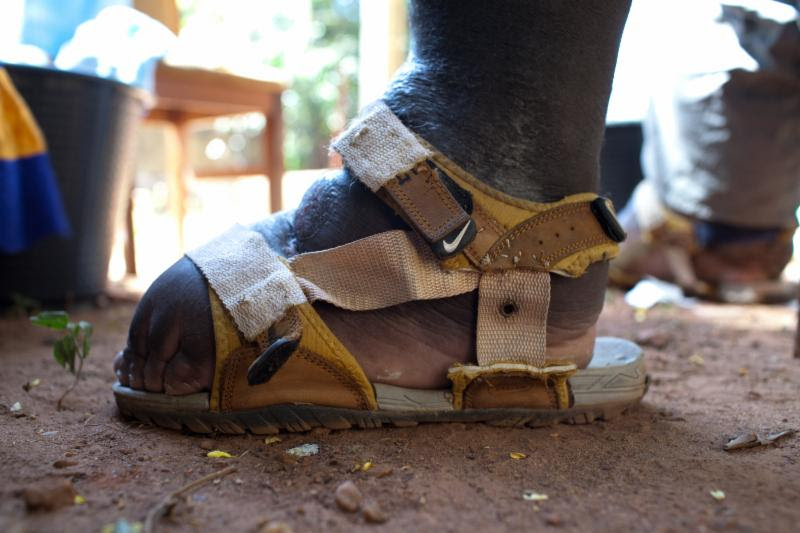 IDA treatment, a new triple-drug therapy with the potential to reduce the time to treat and break-transmission of lymphatic filariasis (LF) from at least five years down to two years, was piloted in a tremendous effort led by the Kenyan Ministry of Health and supported by a consortium of international partners.