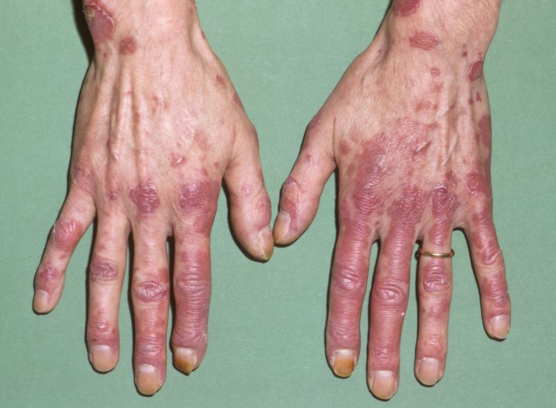 Lupus is an autoimmune disease that occurs when the body's defence system produces antibodies that attack your own tissues causing an inflammation as opposed to the immune system protecting the body from infections.