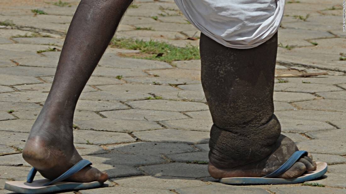 Civil Society Organizations (CSOs) have joined together to create Africa’s first civil society network for Neglected Tropical Diseases - the Civil Society Says No to NTDs Coalition.
