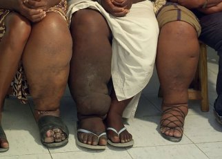 Drive to Eliminate Elephantiasis in East Africa