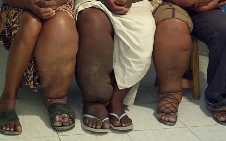 Drive to Eliminate Elephantiasis in East Africa